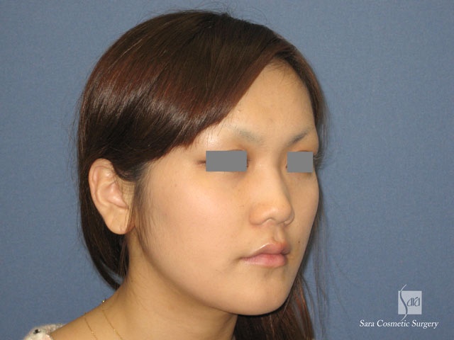 エラ削り（口外法）術後６ヶ月斜面