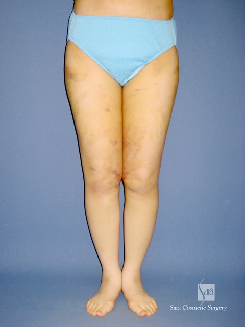 太もも、お尻の抜糸時（１週間後）