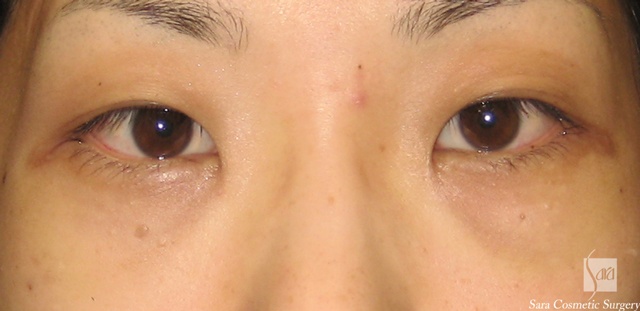 経結膜脂肪除去手術直後