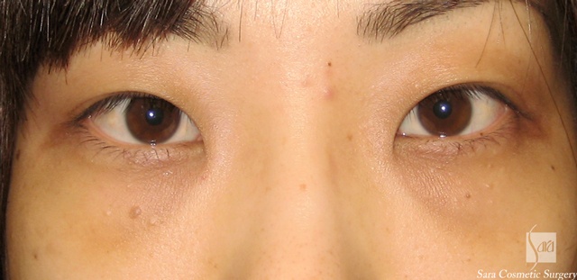 経結膜脂肪除去手術後4日目