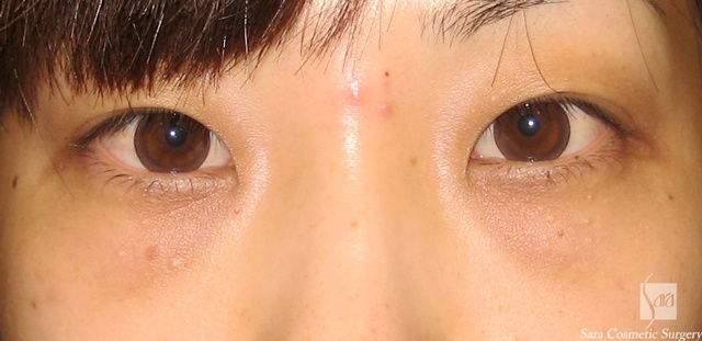 経結膜脂肪除去手術後10日目