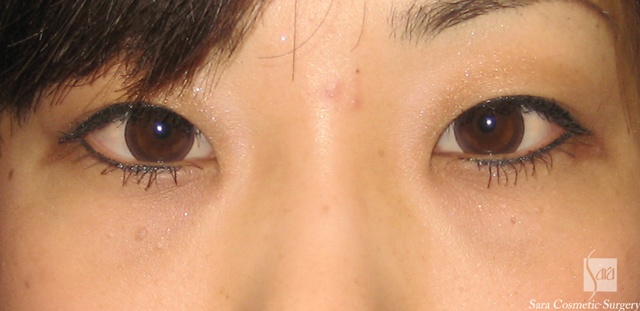 経結膜脂肪除去手術後1ヶ月目