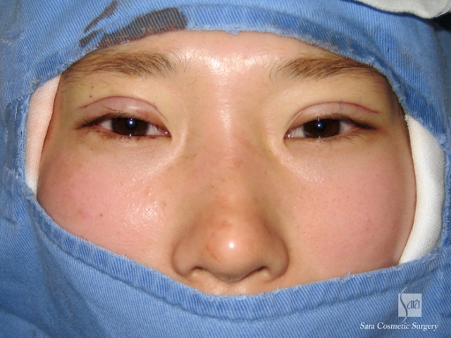 二重（全切開）＋タルミ取り手術中