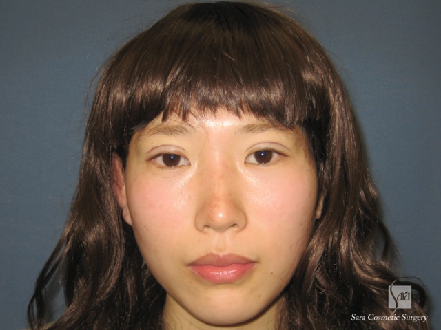 二重（全切開）＋タルミ取り手術直後