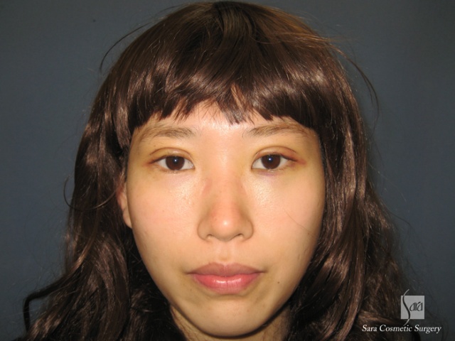 二重（全切開）＋タルミ取り手術後3日目