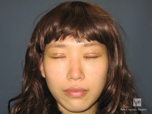 二重（全切開）＋タルミ取り手術後3日目閉眼