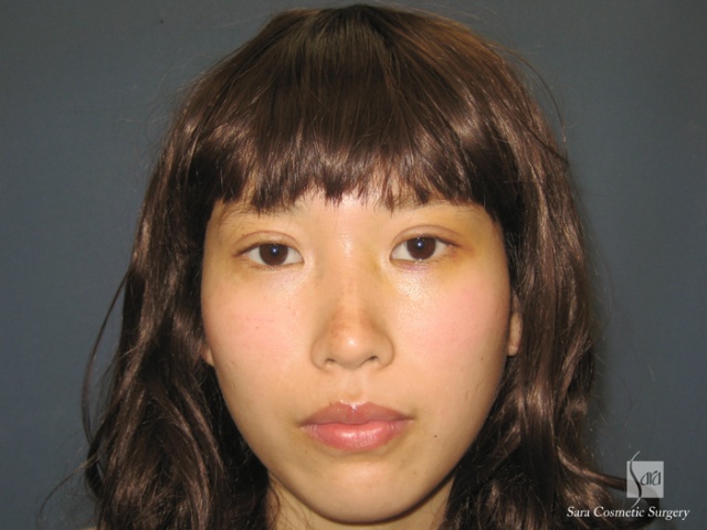 二重（全切開）＋タルミ取り手術後6日目抜糸