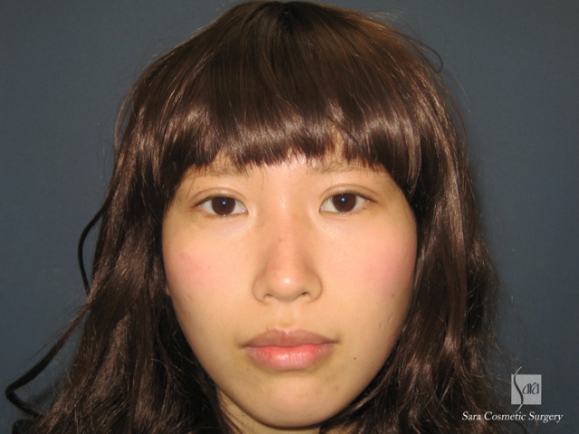 二重（全切開）＋タルミ取り手術後14日目