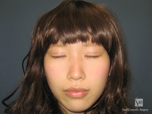 二重（全切開）＋タルミ取り術後14日目閉眼