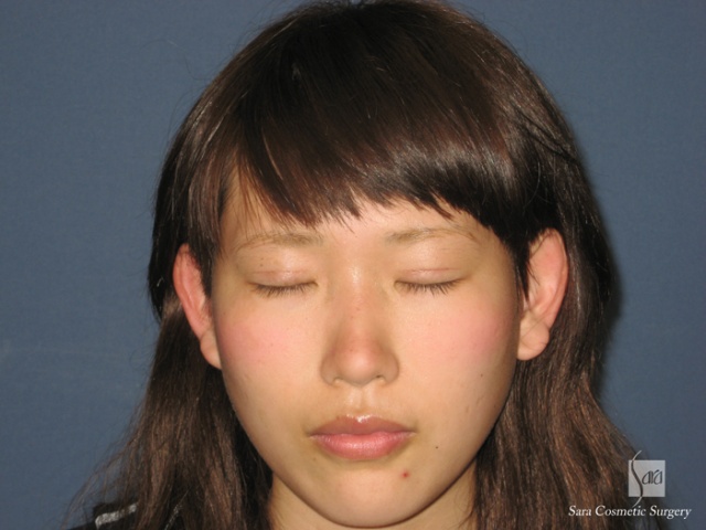 二重（全切開）＋タルミ取り手術後1ヶ月閉眼