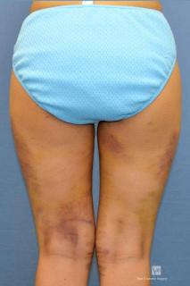 豊胸（脂肪注入）術後５日目