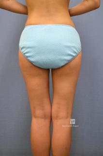 豊胸（脂肪注入）術後１ヶ月