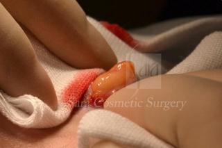 眼瞼下垂＋目頭切開術中（眼窩内脂肪）