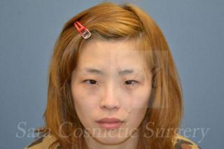 眼瞼下垂＋目頭切開術前