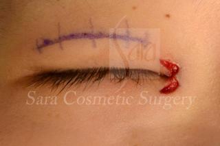 眼瞼下垂＋目頭切開術中