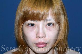 眼瞼下垂手術と目頭切開のモニターさんの術後52日目