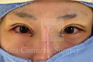 眼瞼下垂＋目頭切開術中