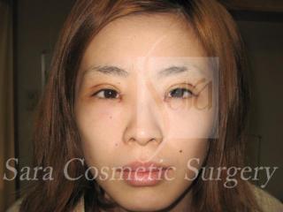 眼瞼下垂手術と目頭切開のモニターさん術後2日目