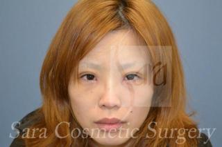 眼瞼下垂手術と目頭切開のモニターさんの5日目（抜糸）