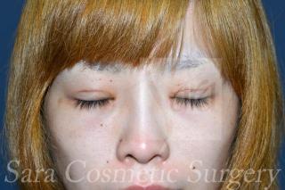 眼瞼下垂手術と目頭切開のモニターさんの術後52日目