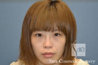 眼瞼下垂手術と目頭切開のモニターさんの術後3ヶ月（ノーメイク）