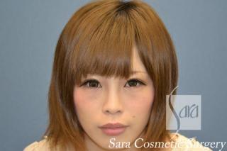 眼瞼下垂手術と目頭切開のモニターさんの術後3ヶ月（メイク）