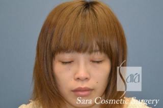 眼瞼下垂手術と目頭切開のモニターさんの術後3ヶ月（ノーメイク）